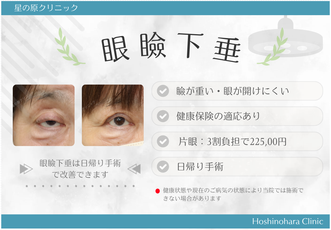 福岡での保険診療での眼瞼下垂の治療をお考えの方