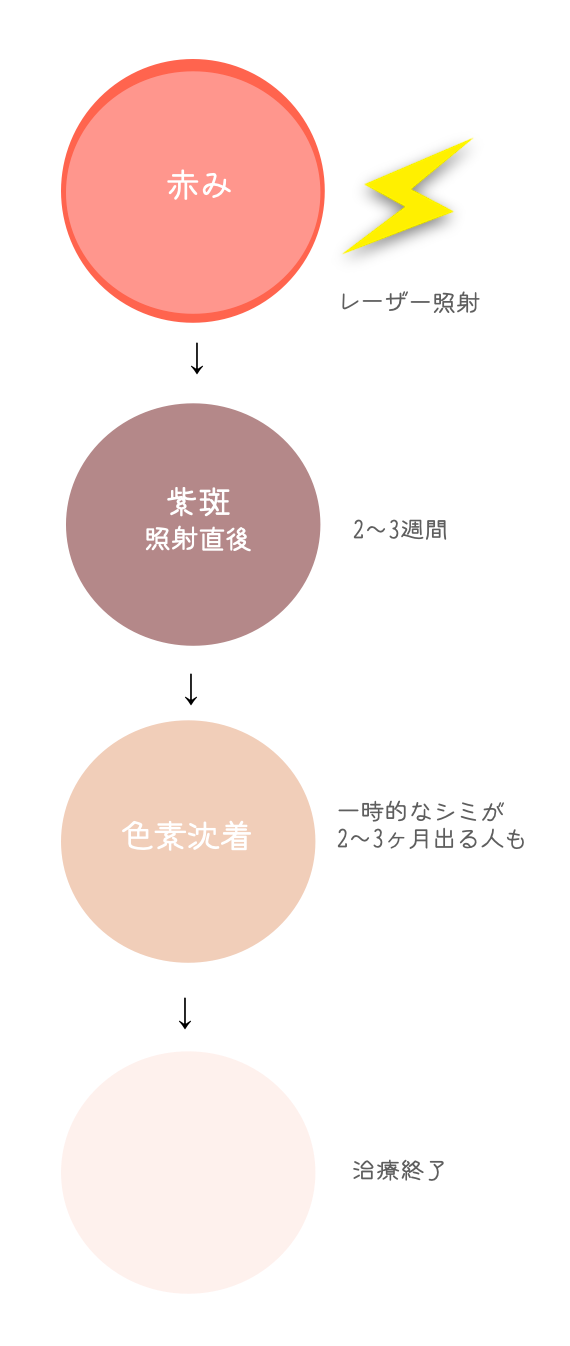 赤ニキビ跡レーザー