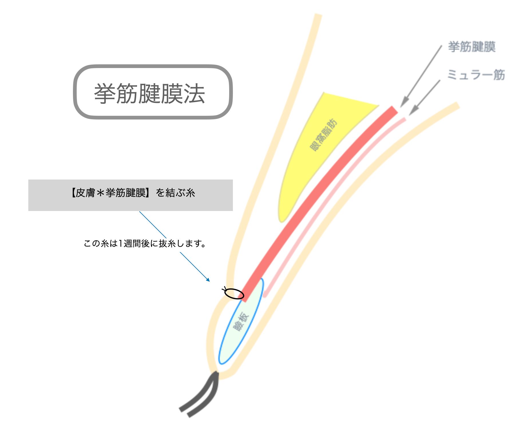 福岡 切開法 二重 挙筋腱膜法