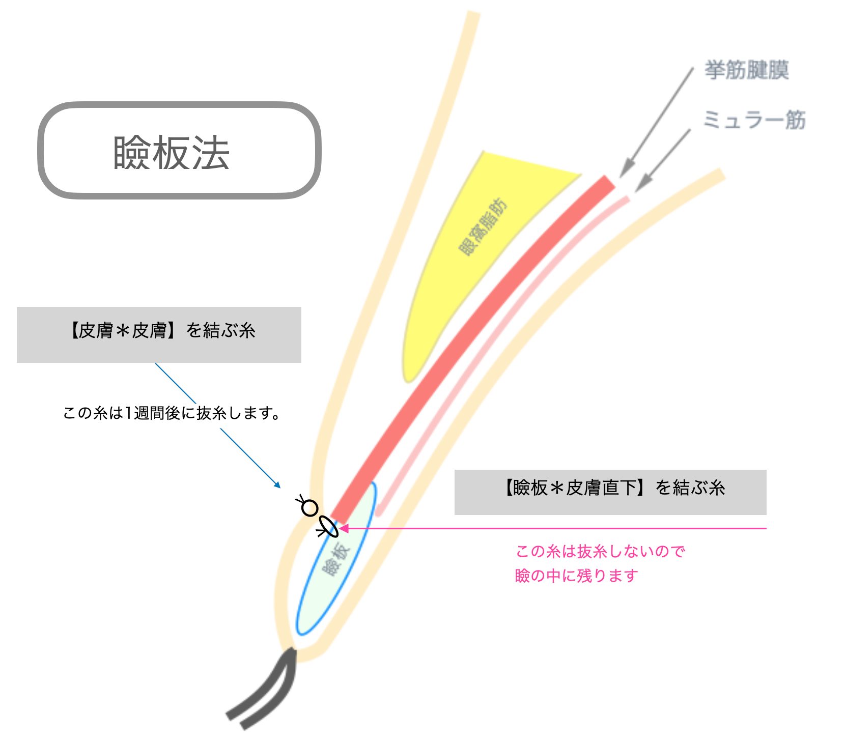 福岡 切開法 二重 瞼板法