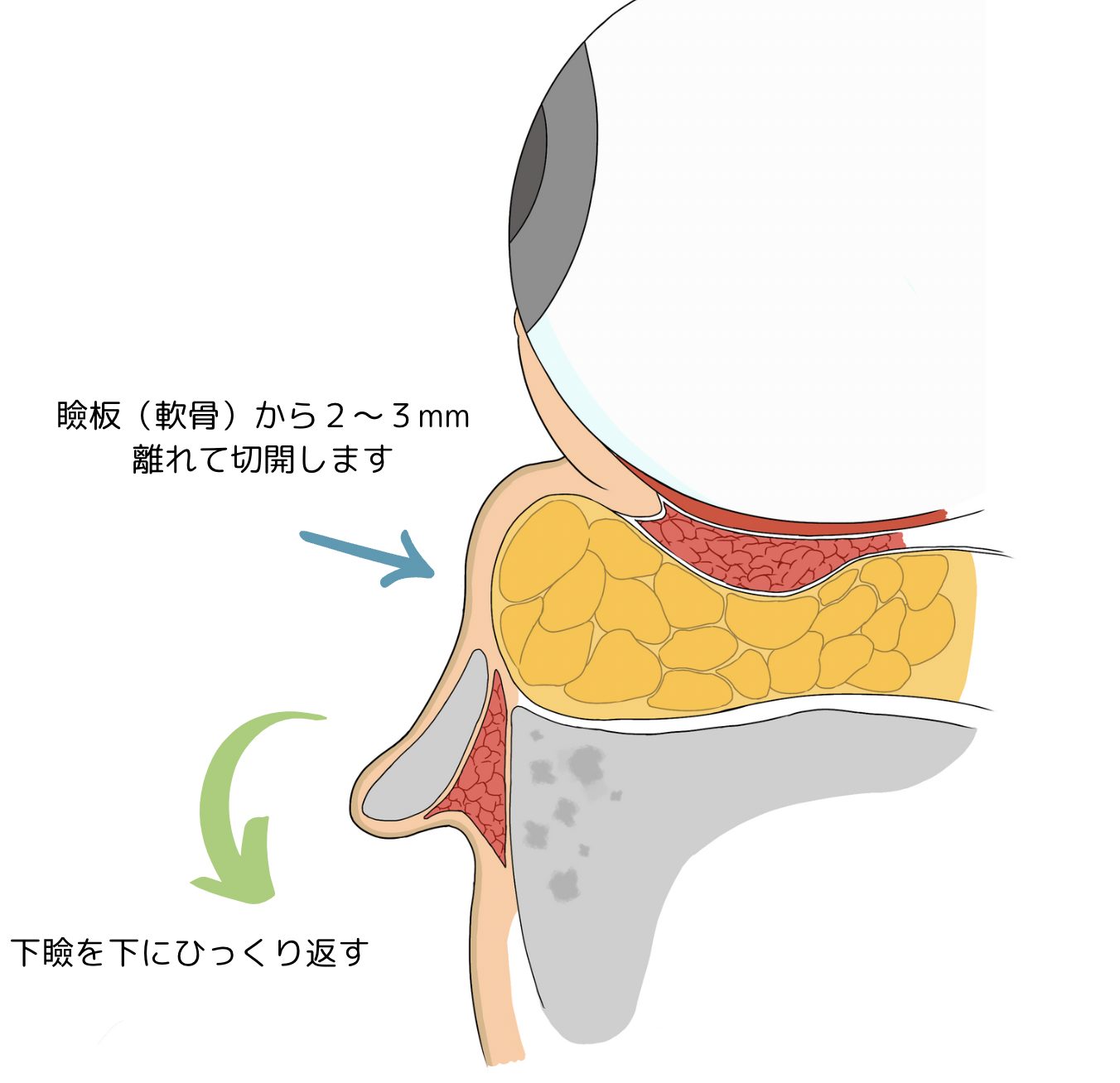 下瞼脱脂 手術アプローチ