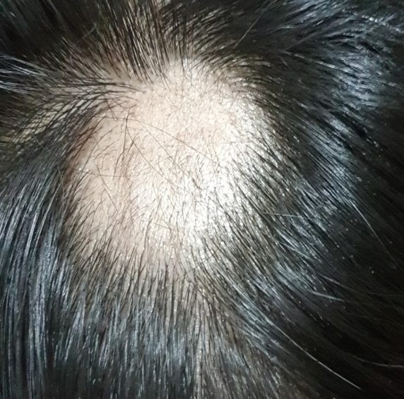 Pseudocyst of scalp